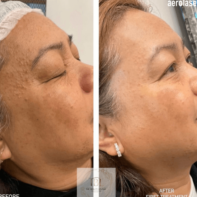 Melasma Renewal – 5