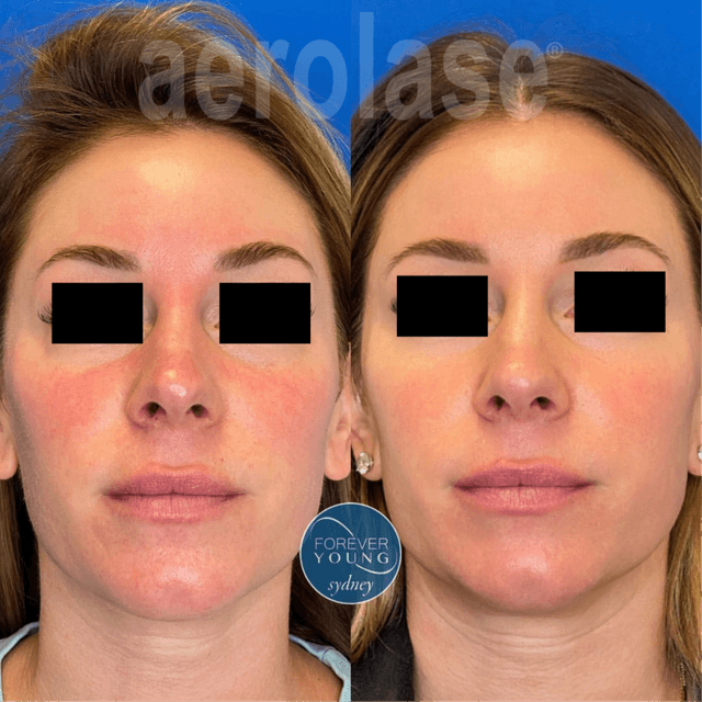 NeoRosacea – 5 Session Package