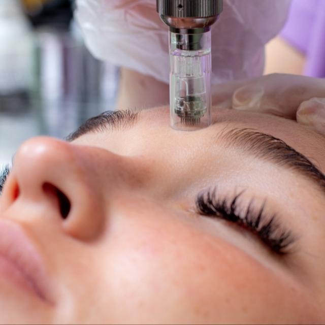 Microneedling – 3 Session Package