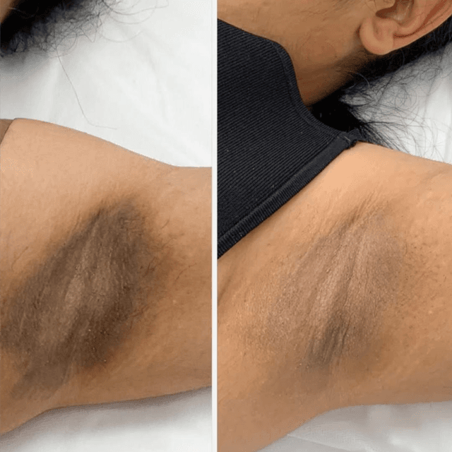 Underarm Correction at Skin 4 Glow Inc in MOHEGAN LAKE, NY